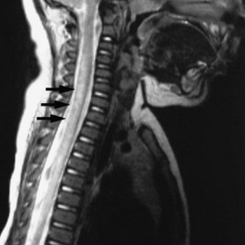 Рентген позвоночника: стрелками показана задняя спинальная артерия