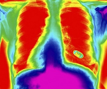 Позитронно-эмиссионная томография при раке легкого