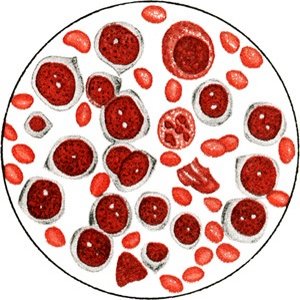 Микроскопия крови больного острым лимфобластным лейкозом