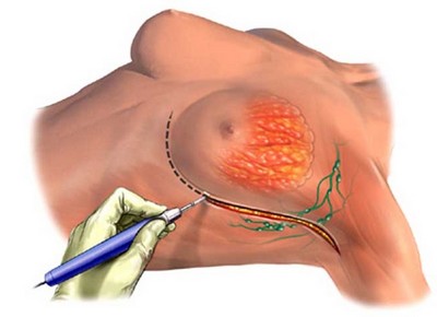 Мастэктомия - хирургическое лечение рака молочной железы