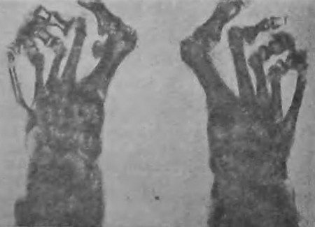 Рентгеновский снимок стоп с hallux valgus, сделанный в послевоенные годы