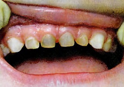 Фронтальная группа зубов с аплазией эмали вестибулярной поверхности у ребенка 2 лет в течение 6 мес. регулярно обрабатывалась ДГЛ.