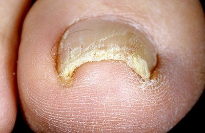 Где можно заразится грибка ногтей