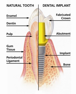 Сравнение натурального зуба и дентального импланта