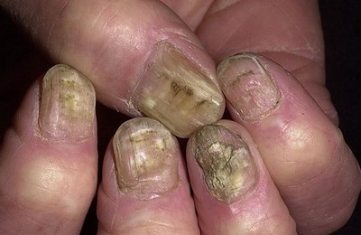 Как лечить грибок ногтей