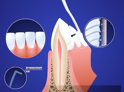 Механизм действия фторирования зубов