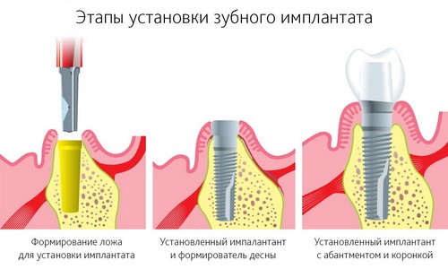 Какие основные этапы имплантации зубов?
