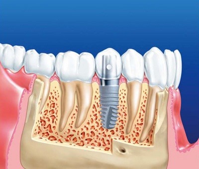 Имплантация зуба и ее преимущества