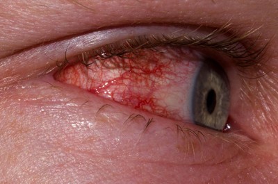 Причины заболевания глаз внешнего характера