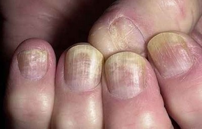 Какие симптомы грибка ногтей