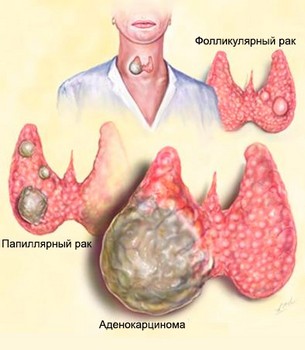 Симптомы и диагностика рака щитовидной железы