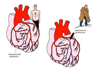 Боли в сердце при физнагрузке - самый распространенный симптом сердечной недостаточности