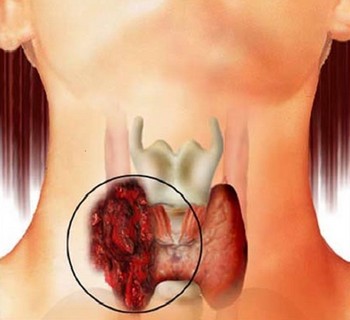 Какие существуют разновидности рака щитовидной железы и почему он появляется