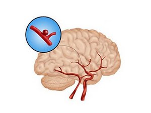 Аневризма стенки сосуда в головном мозге