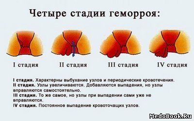 лечение геморроя