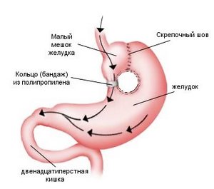 Операция вертикальная гастропластика
