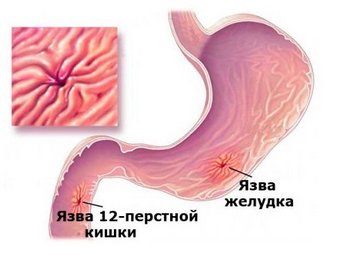 Язвенная болезнь желудка и двенадцатиперстной кишки