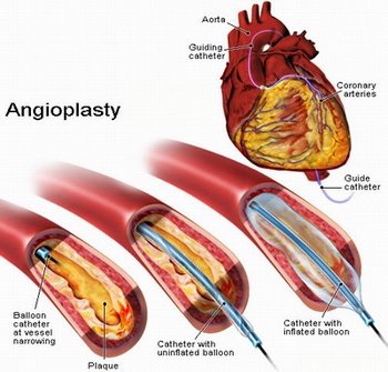 Коронарная ангиопластика (стентирование) - основной метод лечения ишемической болезни сердца