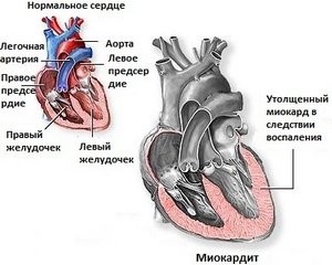 http://hnb.com.ua/articles/s-zdorovie-miokardit-3453
