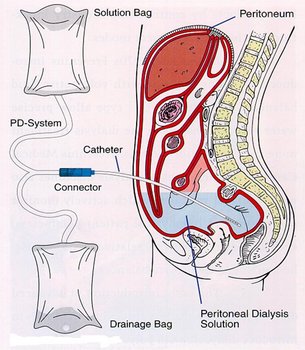 Принципиальная схема перитониального диализа