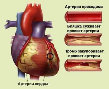 Атеросклероз - основная причина ишемической болезни сердца