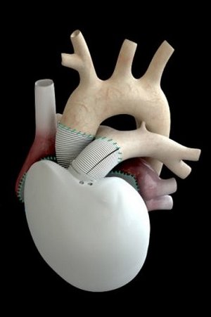 Скачать бесплатно книгу, учебник по медицине Французам удалось пересадить уникальное искусственное сердце