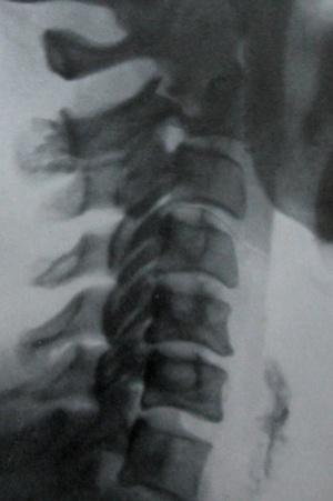 Скачать бесплатно книгу, учебник по медицине Рентгенографическая диагностика перелома дуги эпистрофея