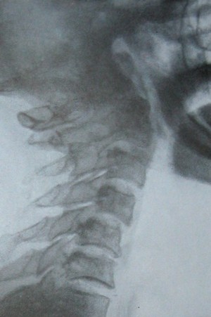 Скачать бесплатно книгу, учебник по медицине Рентгенографическая диагностика переломо-вывиха атланта и эпистрофея с переломом остистого отростка 3 шейного позвонка