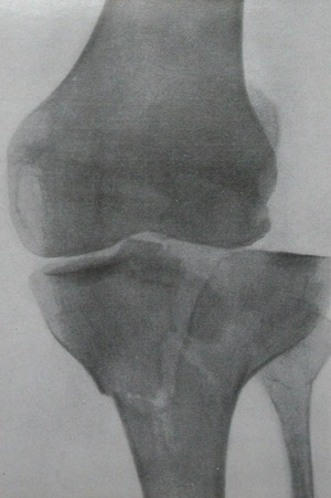 Скачать бесплатно книгу, учебник по медицине Рентгенодиагностика двумыщелкового перелома большеберцовой кости с вдавлением