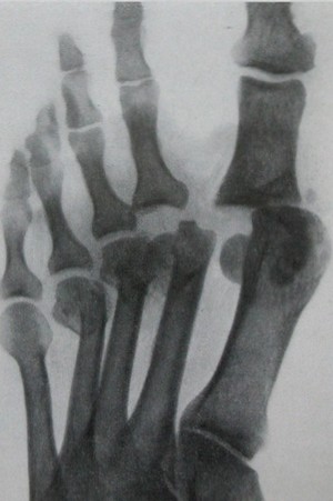 Скачать бесплатно книгу, учебник по медицине Перелом головок I и IV плюсневых костей с вывихом I и II пальцев стопы