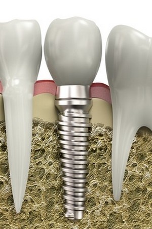 Скачать бесплатно книгу, учебник по медицине Почему следует выбрать имплантацию зубов?