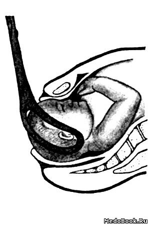 Скачать бесплатно книгу, учебник по медицине Открытие наружного зева шейки матки - условие для наложения щипов