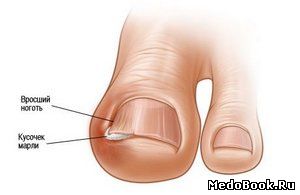 Лечение вросшего ногтя в мыльном растворе с приподнятием вросшего края при помощи кусочка марли