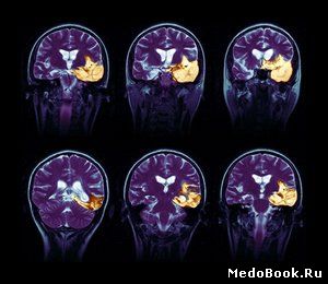 МРТ головного мозга больного герпетическим энцефалитом