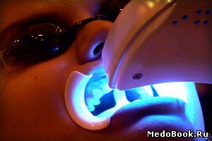 Каким образом происходит процедура отбеливания зубов при помощи лазера
