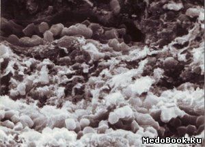 Стенка желудка вокруг хронической язвы на сколе.Микро -канальцы, заполненные микрочастицами активированного угля. СЭМ. Ув.2000.