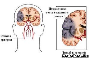 Тромбоз сосуда головного мозга