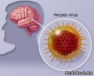 Вирус простого герпеса (ВПГ) - возбудитель герпетического энцефалита