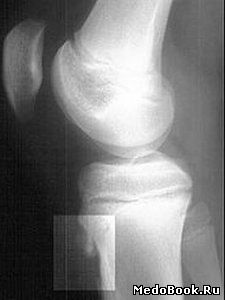 Рентгенограмма коленного сустава больного с болезнью Осгуда — Шлаттера