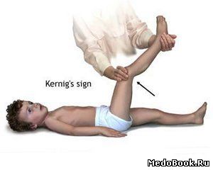 Положительный симптом Кернига при менингите