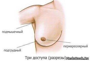 Виды разрезов при увеличении груди