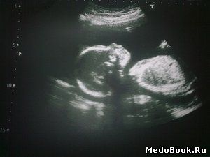 Ультразвуковая картина плода на 21 неделе беременности